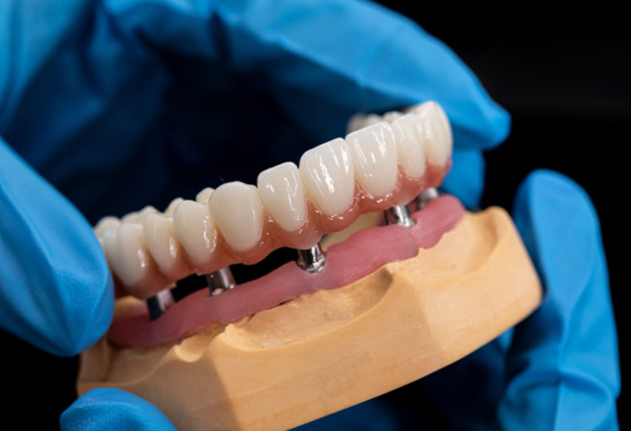 Full-Arch Implant Restorations