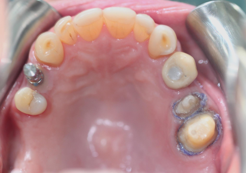 CLINICAL CASES:PERFIT IMPRESSION MATERIALS 1