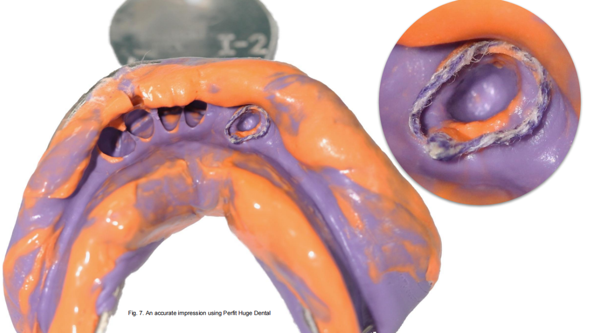 CLINICAL CASES:PERFIT IMPRESSION MATERIALS 4